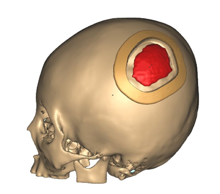 Read more about the article Wzmocnienie implantów chirurgicznych PEEK przy użyciu drukarki 3D